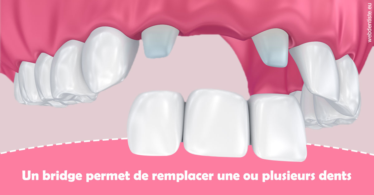https://dr-wintenberger-hugo.chirurgiens-dentistes.fr/Bridge remplacer dents 2