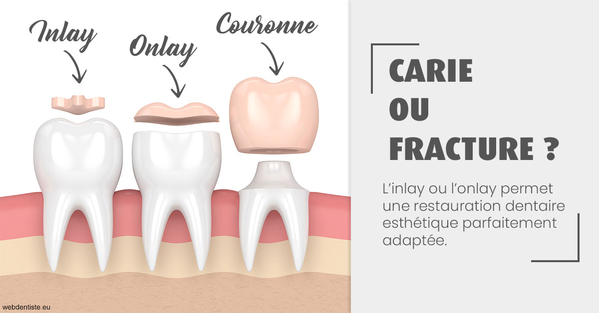 https://dr-wintenberger-hugo.chirurgiens-dentistes.fr/T2 2023 - Carie ou fracture 1