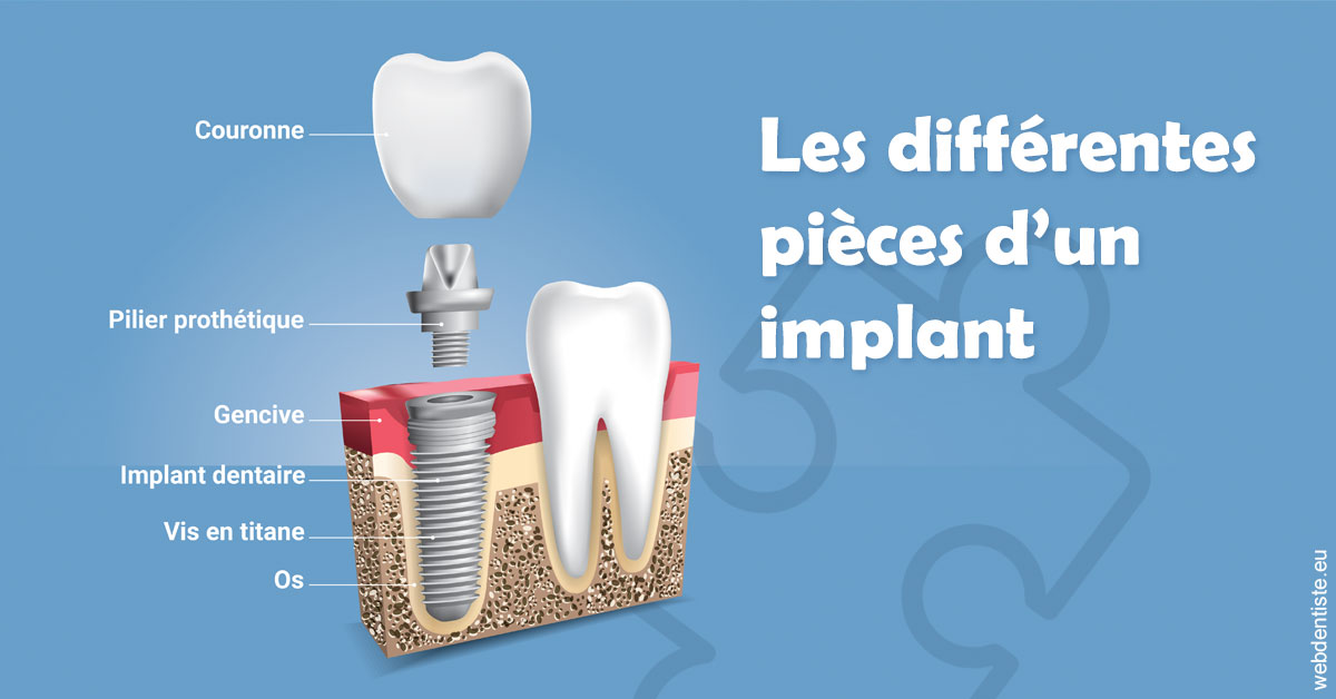 https://dr-wintenberger-hugo.chirurgiens-dentistes.fr/Les différentes pièces d’un implant 1